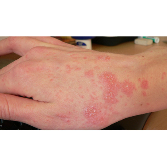 A-Scabies Permethrin Lotion