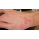 A-Scabies Permethrin Lotion