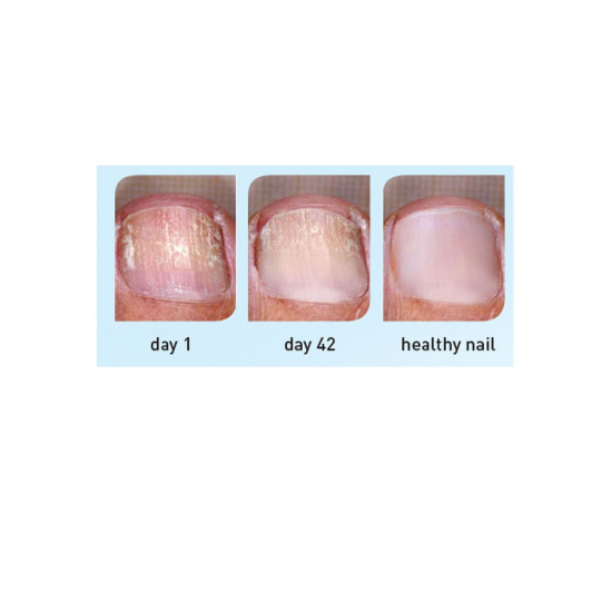 Excilor Pen - Nail Fungal Infection Treatment